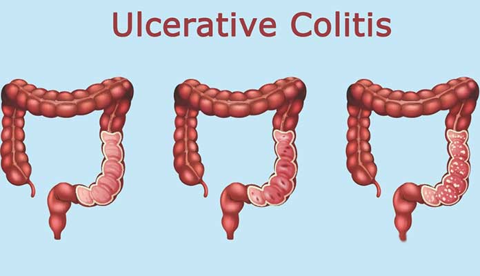 10 Main Causes of Ulcerative Colitis