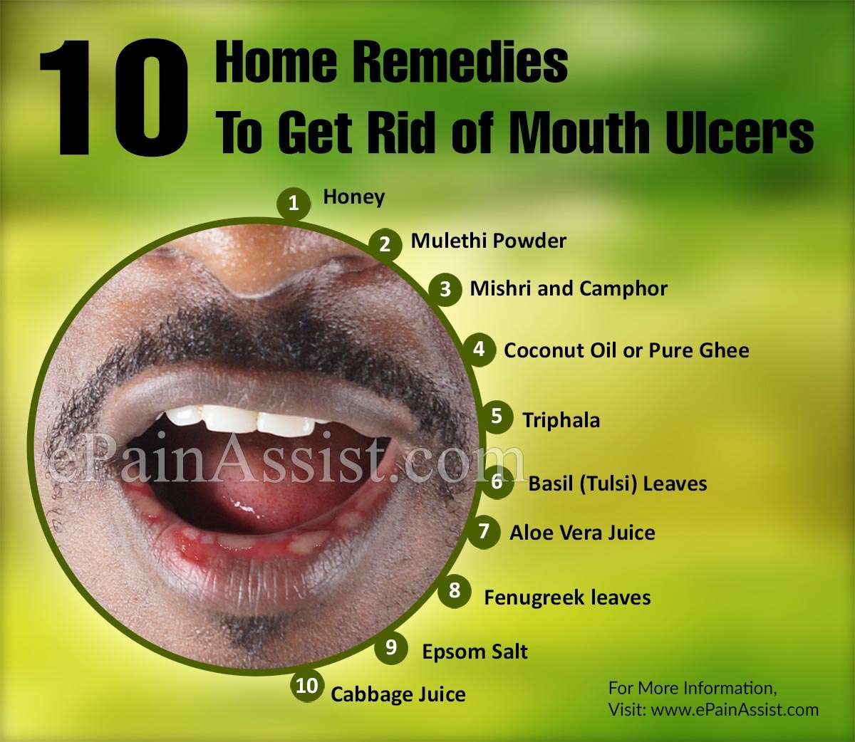 10 Simple Home Remedies To Get Rid Of Mouth Ulcers
