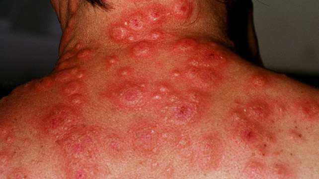 10 Skin Rashes Caused by Ulcerative Colitis