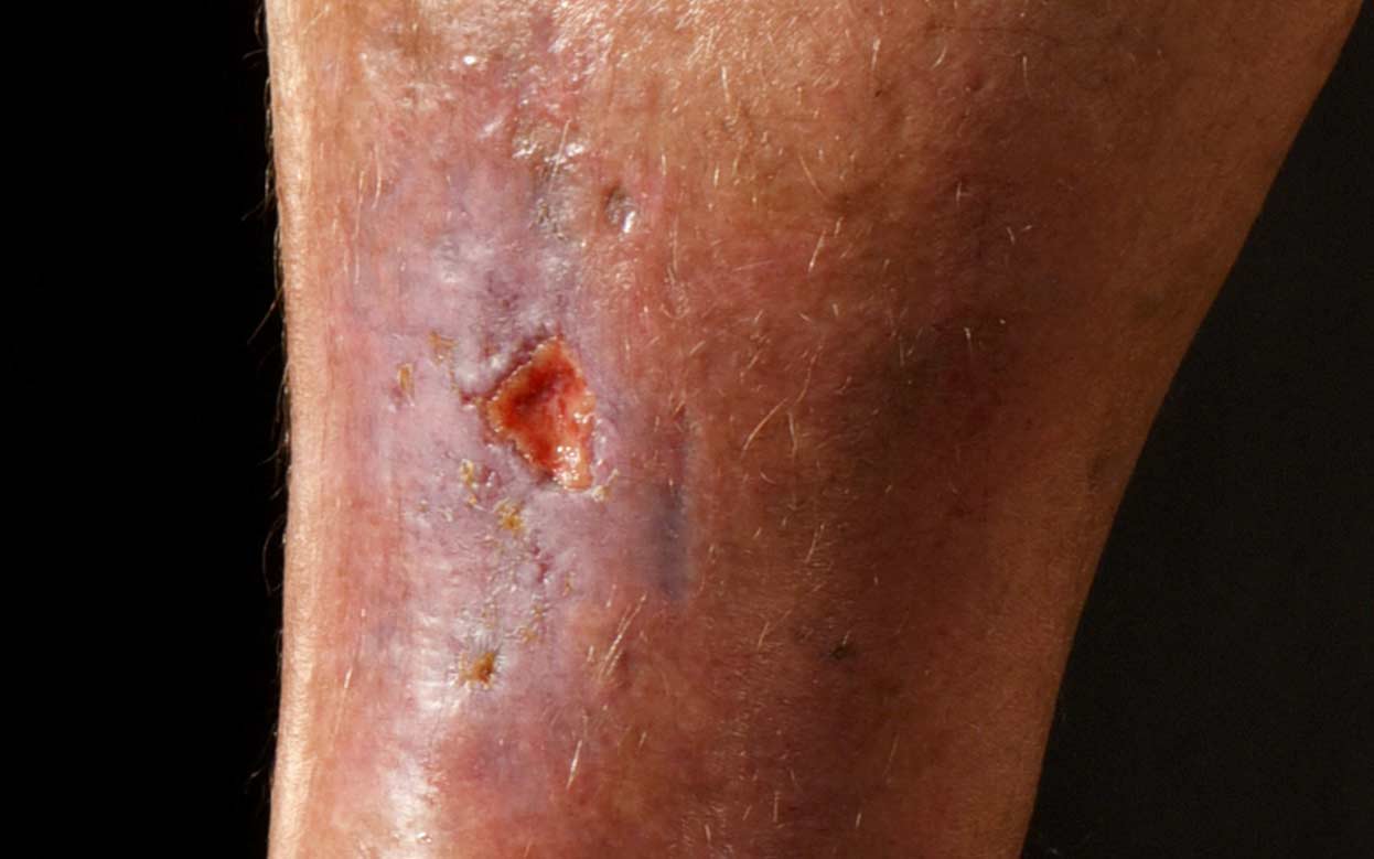 10 Top tips on leg ulcers for healthcare professionals