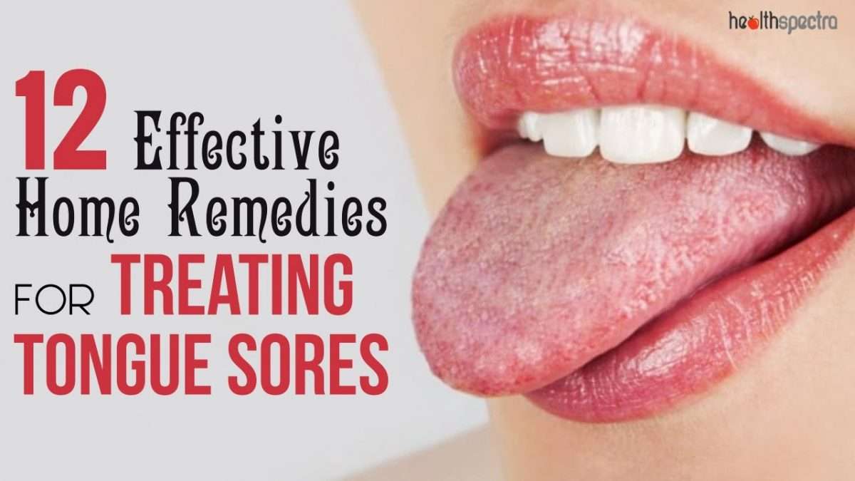 12 Effective Remedies For Treating Tongue Sores