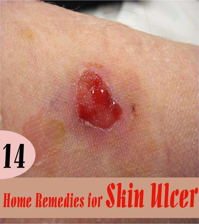14 Home Remedies for Skin Ulcer