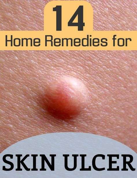 15 Home Remedies for Skin Ulcer