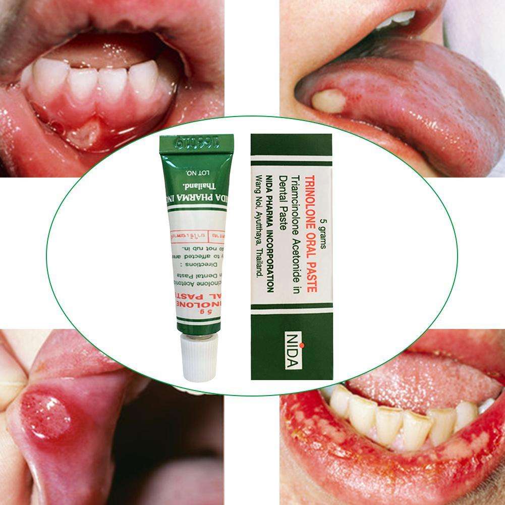 1pcs Mouth Ulcer Relief Gel Natural Herbal Oral ...