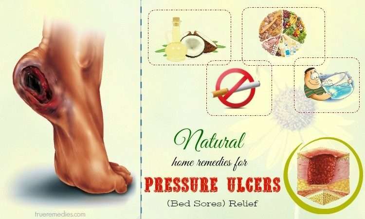 20 Home Remedies For Pressure Ulcers (Bed Sores) Relief
