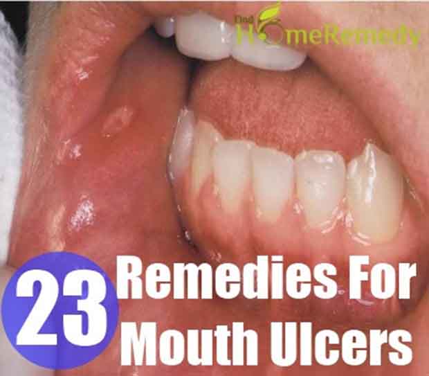 23 Home Remedies For Mouth Ulcers