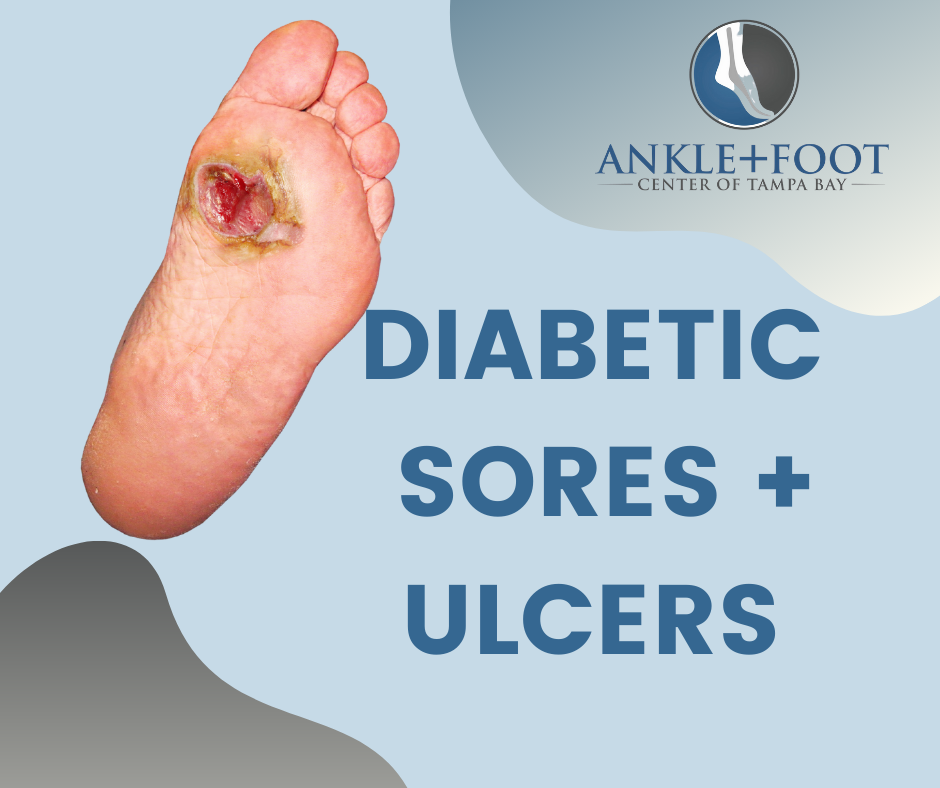 3 things to heal a Diabetic Ulcer