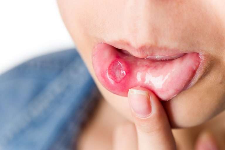 4 Types of Mouth Ulcers Treatments to Do