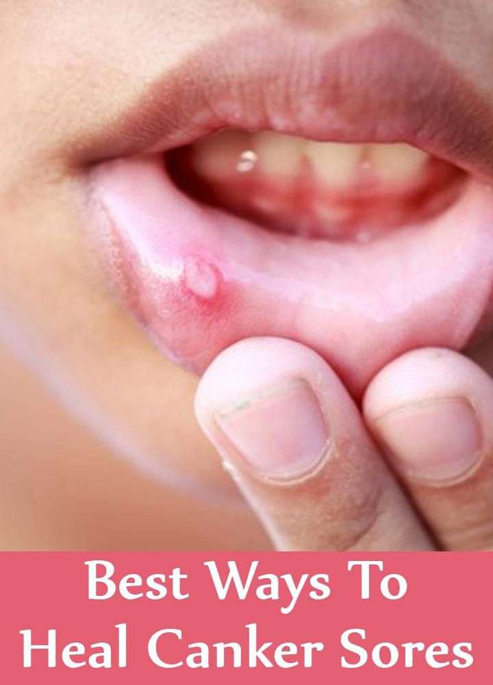 5 Best Ways To Treat Canker Sores