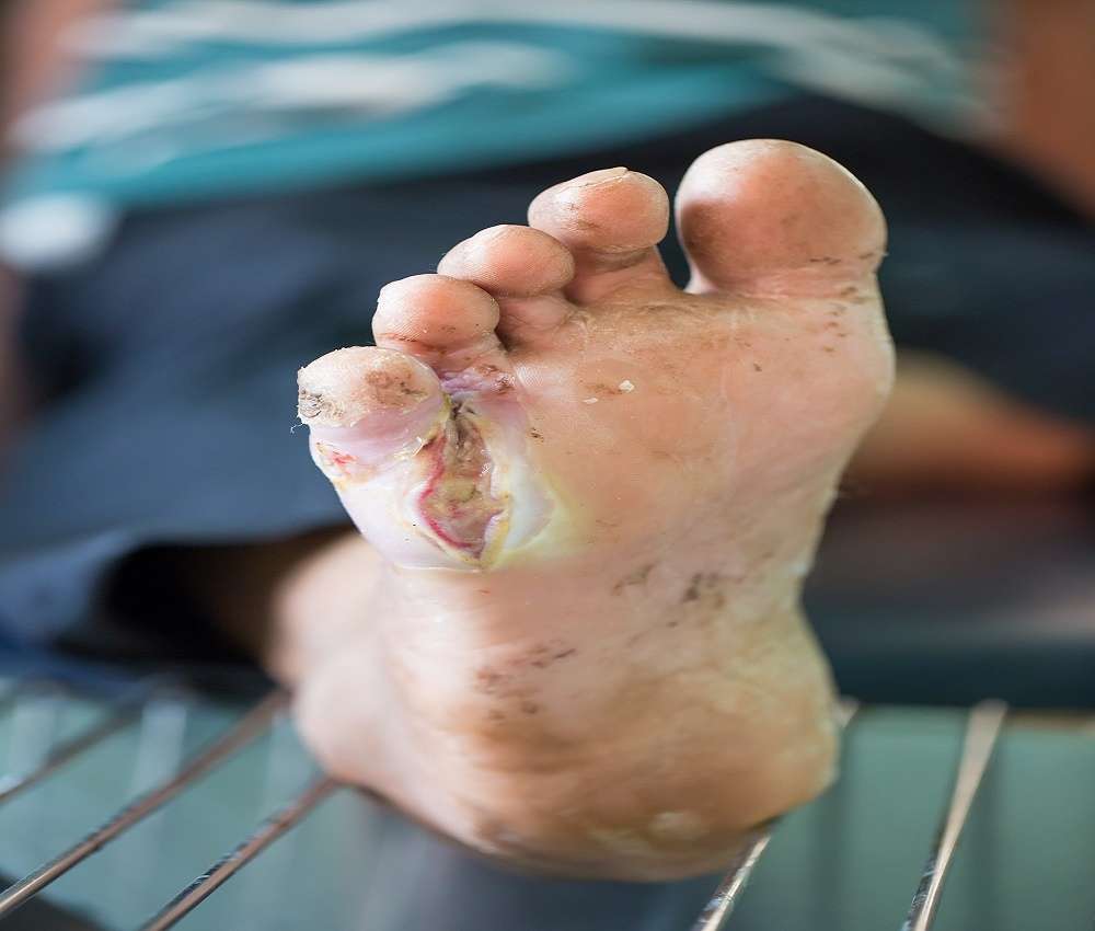 5 Major Causes of Foot Ulcers