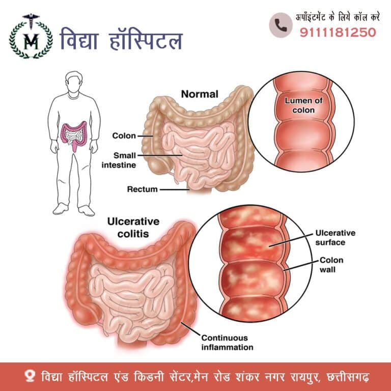 6. Best ulcerative colitis treatment in Raipur, Chhattisgarh