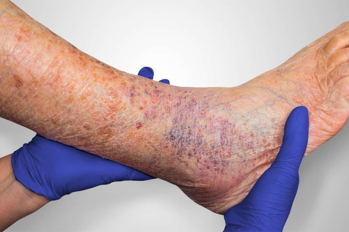 6 things to know when treating venous leg ulcers