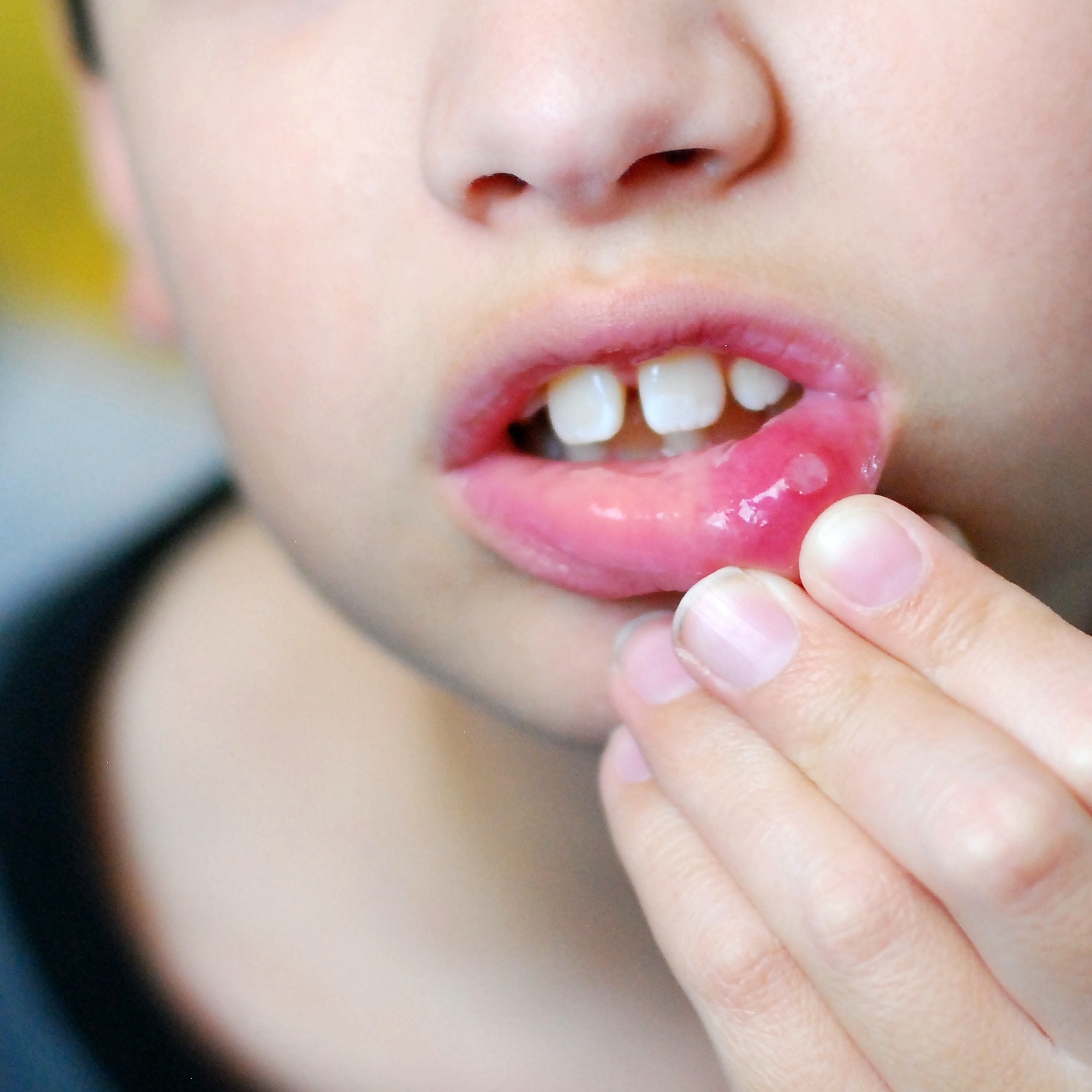 7 Home Remedy for Mouth Ulcer in Children during Summers  mommymomentsapp