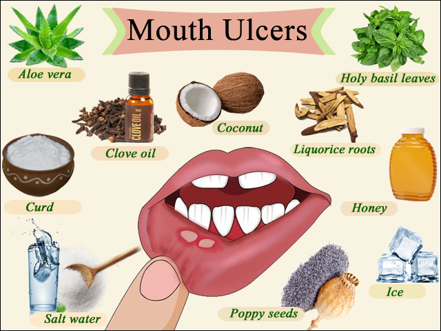 7 Home Remedy for Mouth Ulcer in Children during Summers