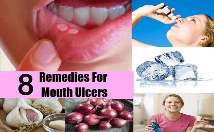 8 Home Remedies to Treat Mouth Ulcers Naturally