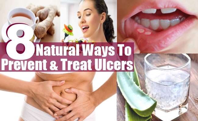 8 Natural Ways To Prevent And Treat Ulcers