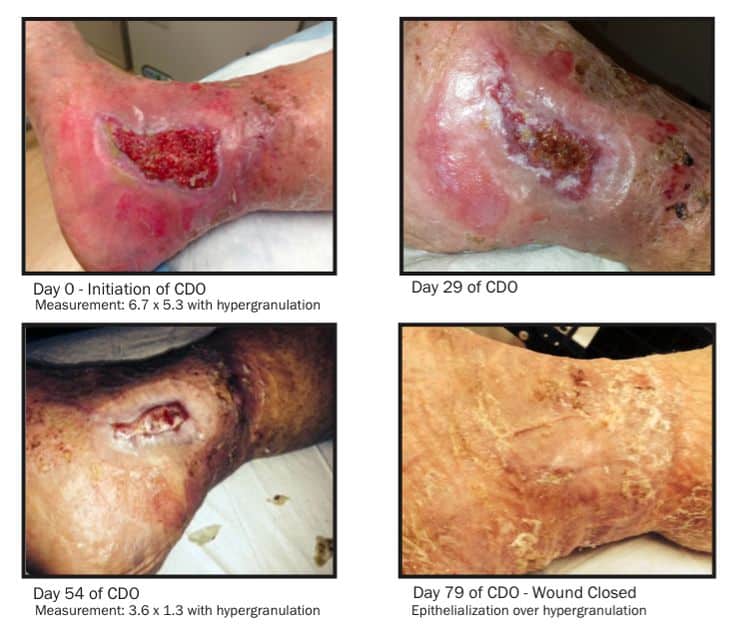 98 best images about Venous Insufficiency Information on Pinterest ...