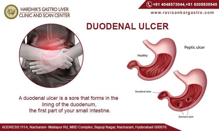 A duodenal ulcer is a sore that forms in the lining of the ...