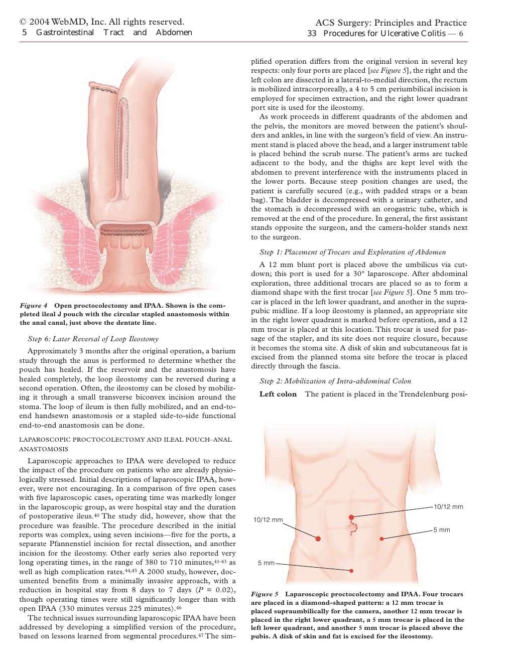 Acs0533 The Surgical Management Of Ulcerative Colitis 2004