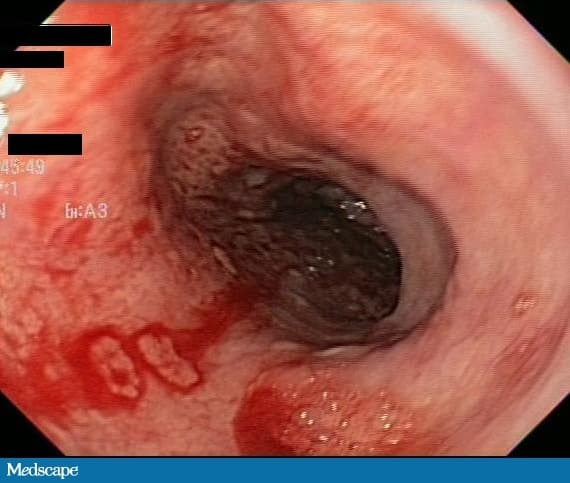 Acute Herpetic Esophagitis in an Immunocompetent Woman