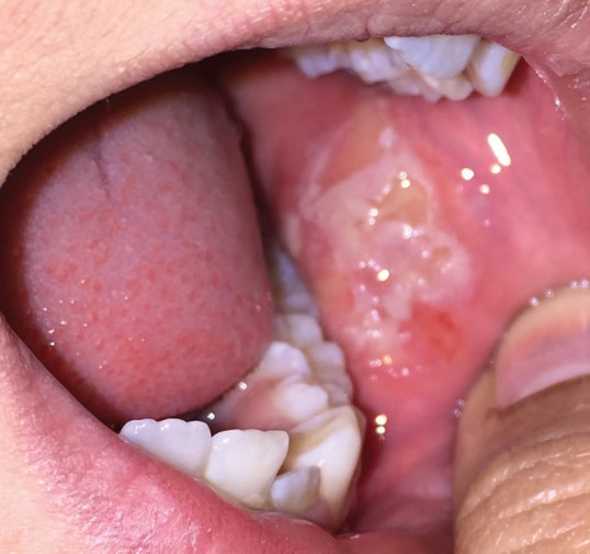 Addressing Ulcerations of the Oral Cavity