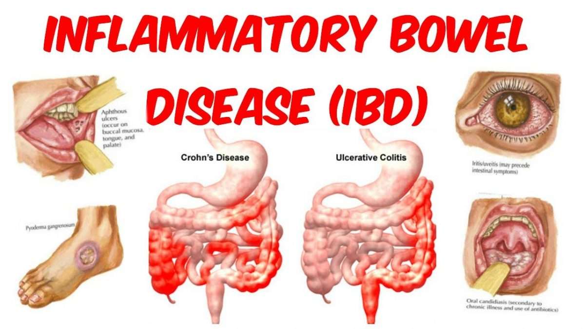 An Introduction To Inflammatory Bowel Disease (Contributing factors to ...