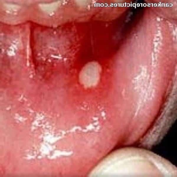 Aphthous Ulcer On The Soft Palate