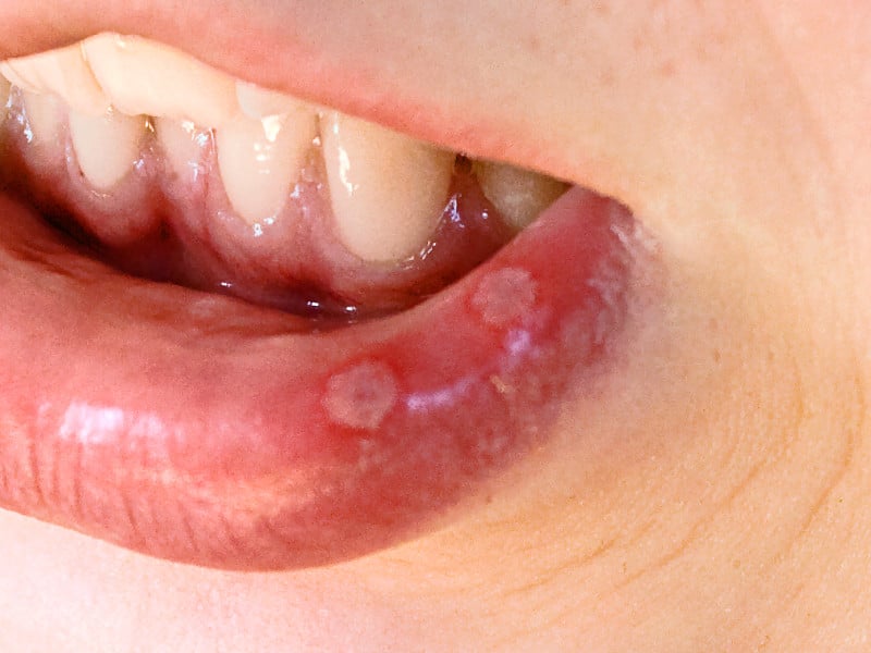 Aphthous Ulcers (Mouth Sores) Causes &  Treatment