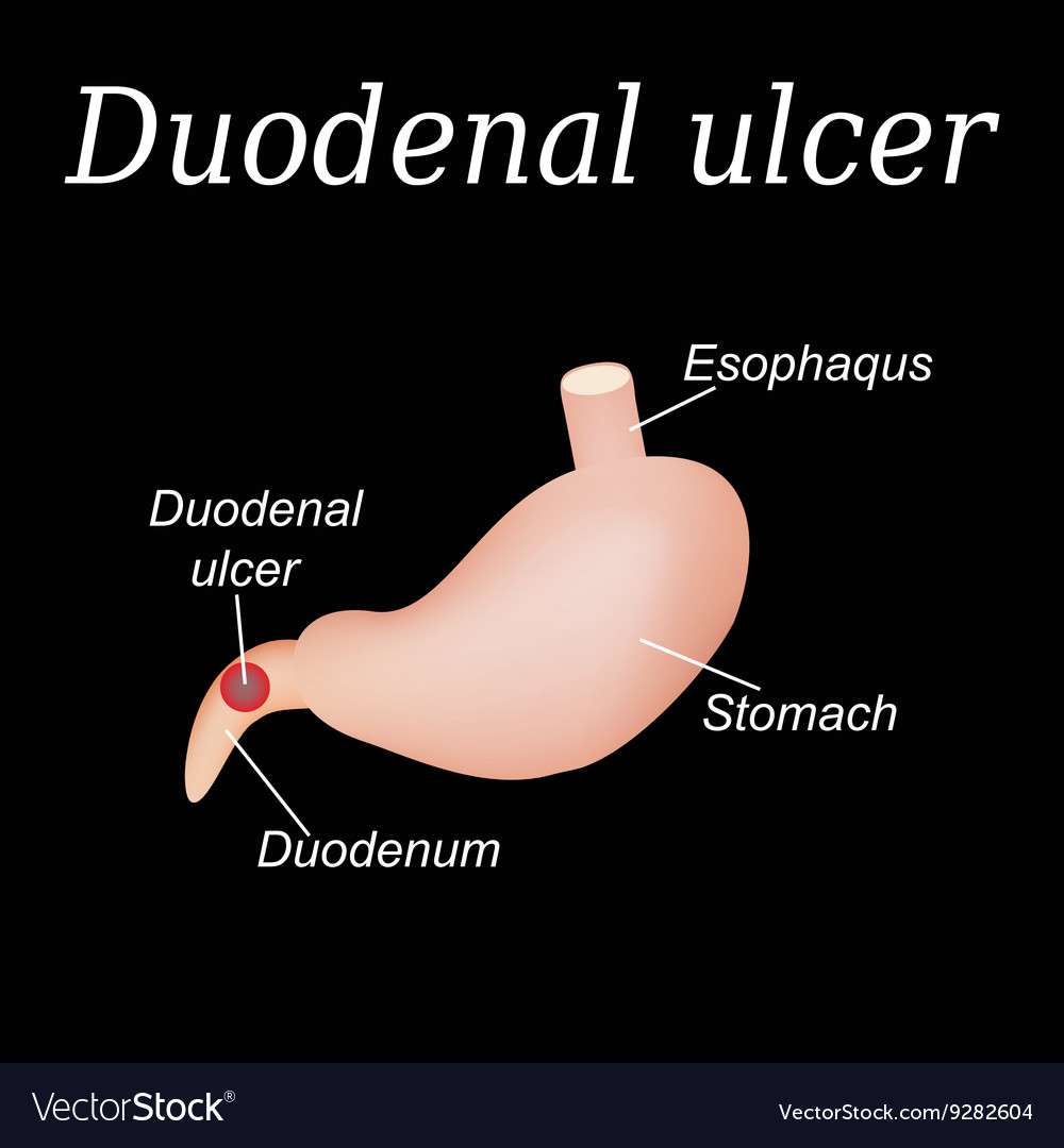 Are you worried about a Peptic ulcer? Know the treatment ...