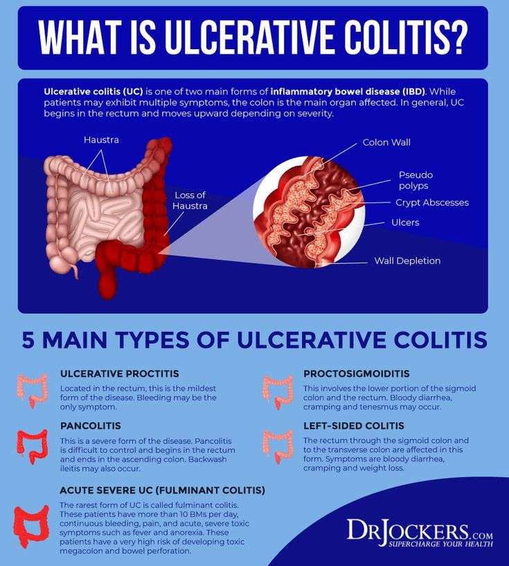 Average Age Of Ulcerative Colitis Diagnosis