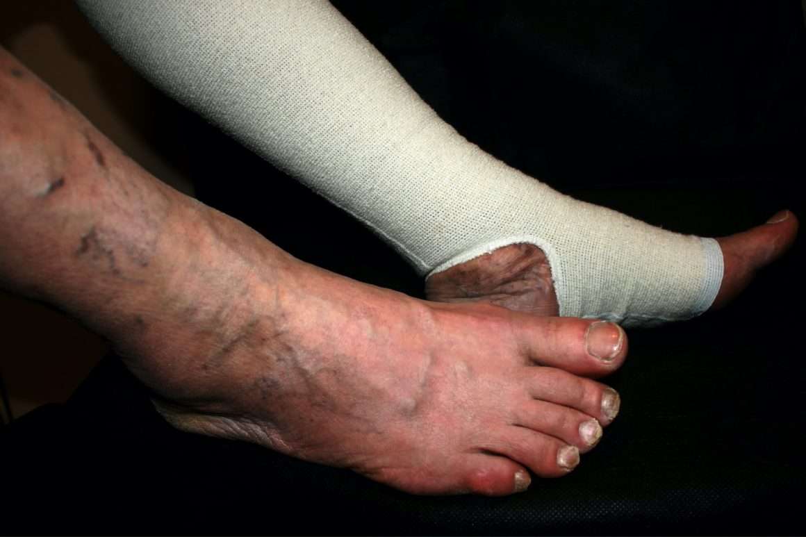 Bandage the Leg Ulcers