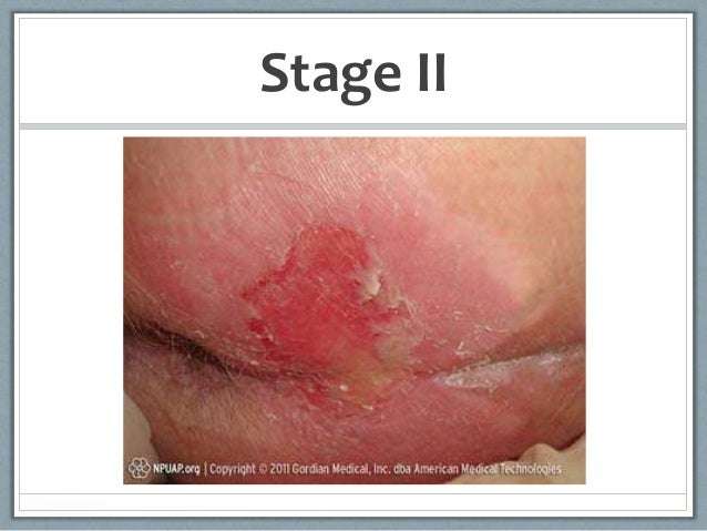 Bed Sores Stage 2