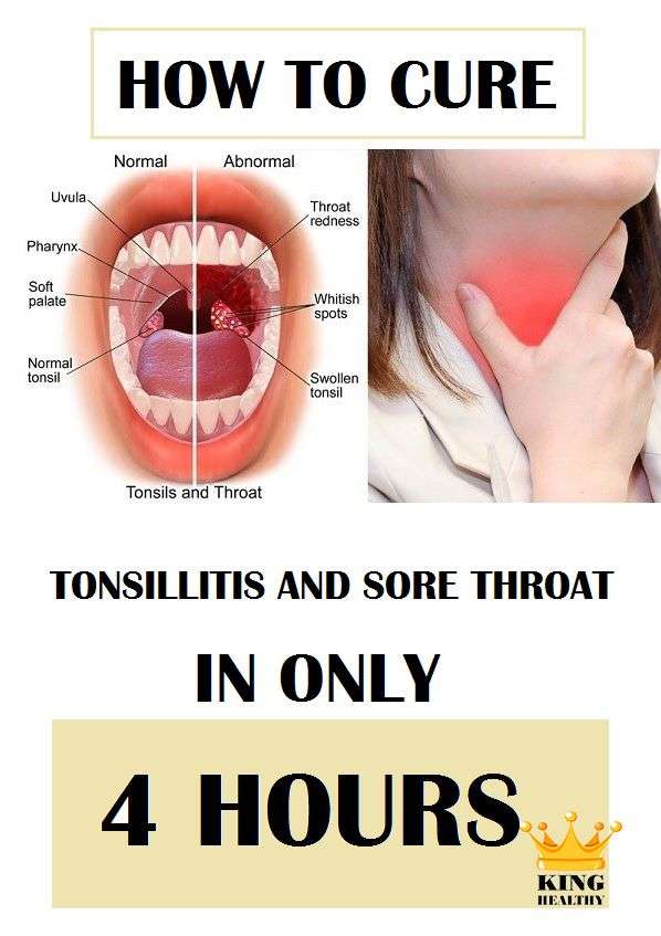 Best way to treat sore throat