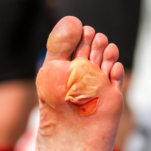 Blister On Bottom Of Foot: How To Prevent It?