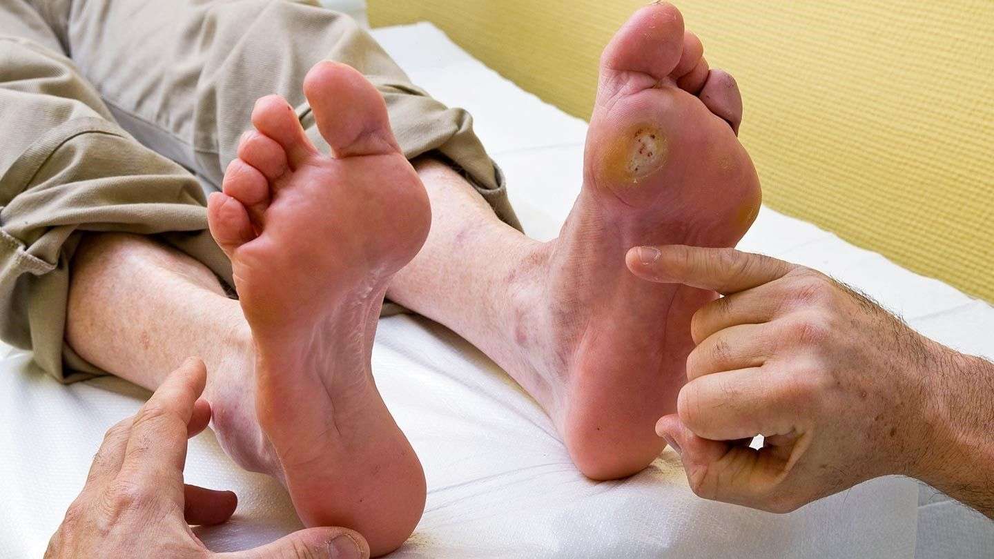 Can Hyperbaric Wound Care Treat Diabetic Foot Ulcers ...