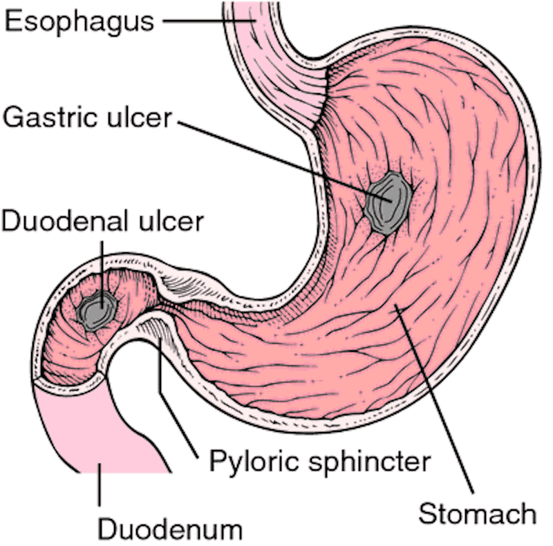 Can Stomach Ulcers Cause Blood In Stool