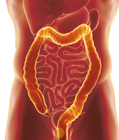 Can Ulcerative Colitis Cause Vomiting