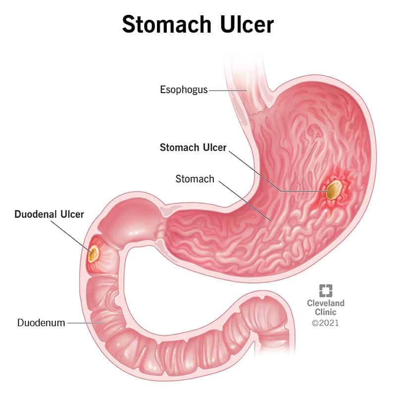 can urgent care diagnose a stomach ulcer