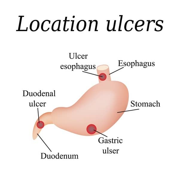 Can you describe peptic ulcer pain?