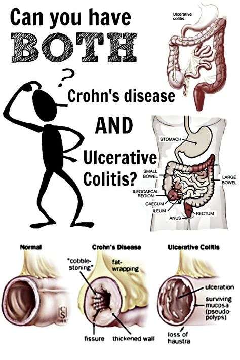 Can You Have BOTH Crohns Disease and Ulcerative Colitis? (With images ...