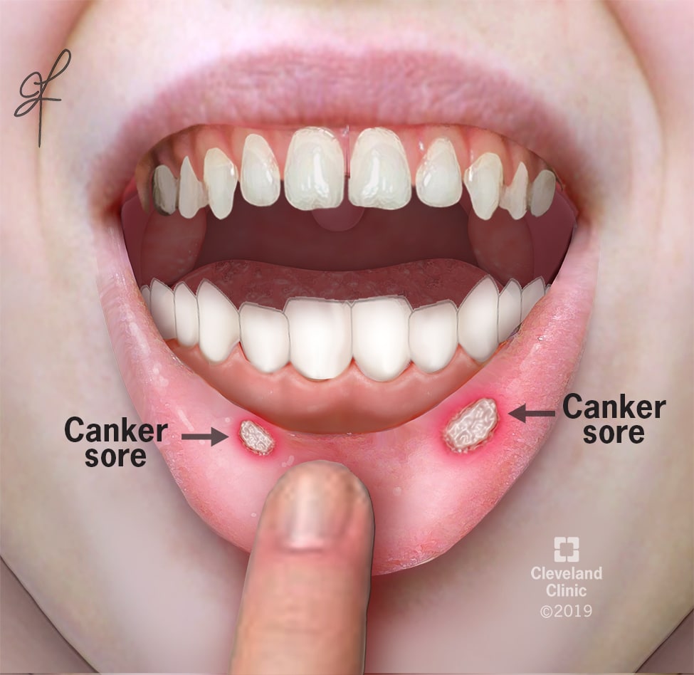 Canker Sore Aphthous Ulcer