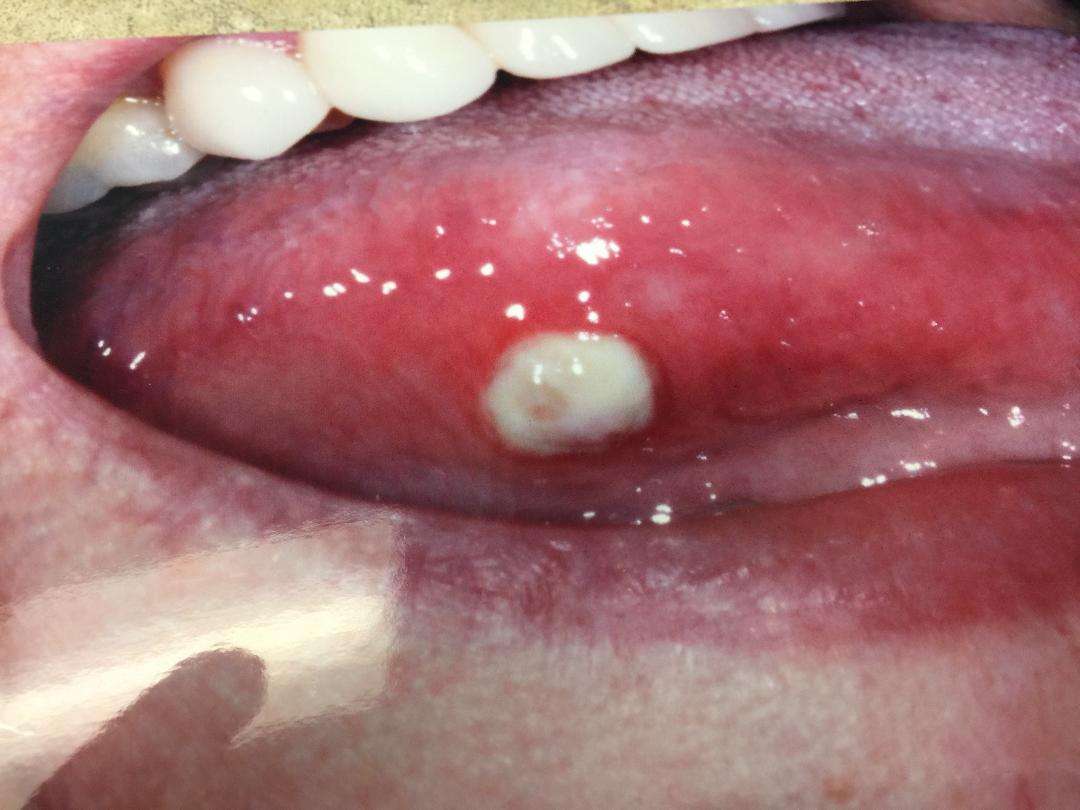 Canker Sore On The Tongue: Picture And Treatment