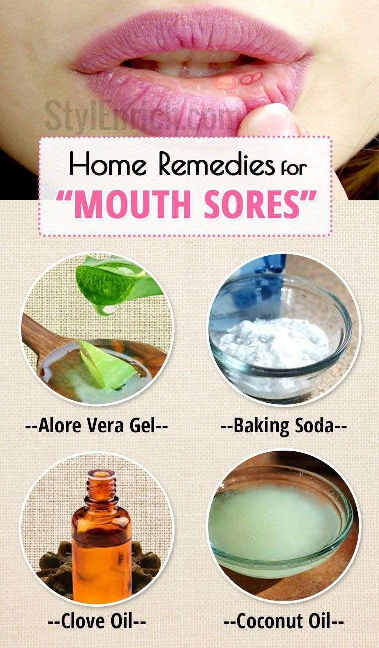 Canker Sores : Home Remedies for Mouth Sores