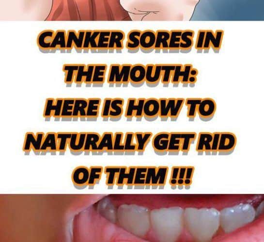 Canker Sores In The Mouth: Here Is How To Naturally Get Rid Of Them ...