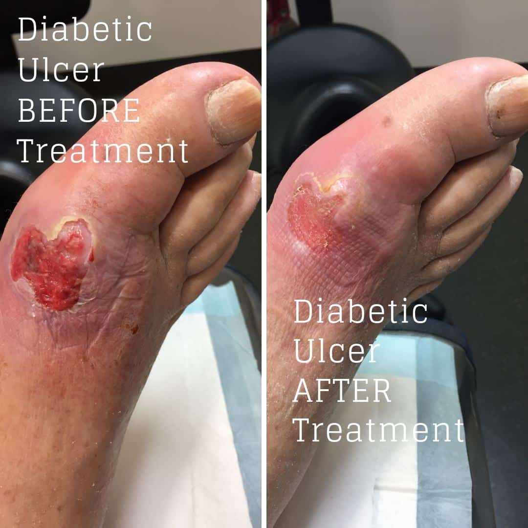 Caring for Your Diabetic Foot