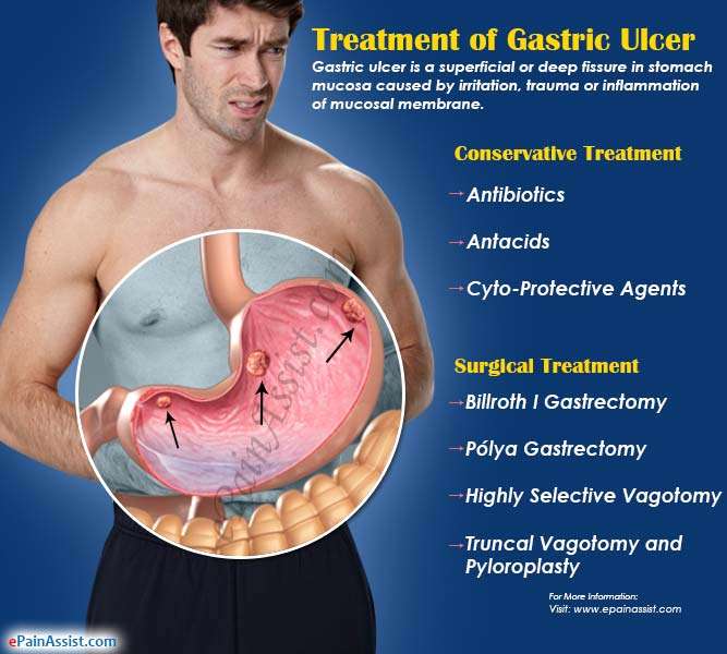 Causes Of Ulcer And Treatment