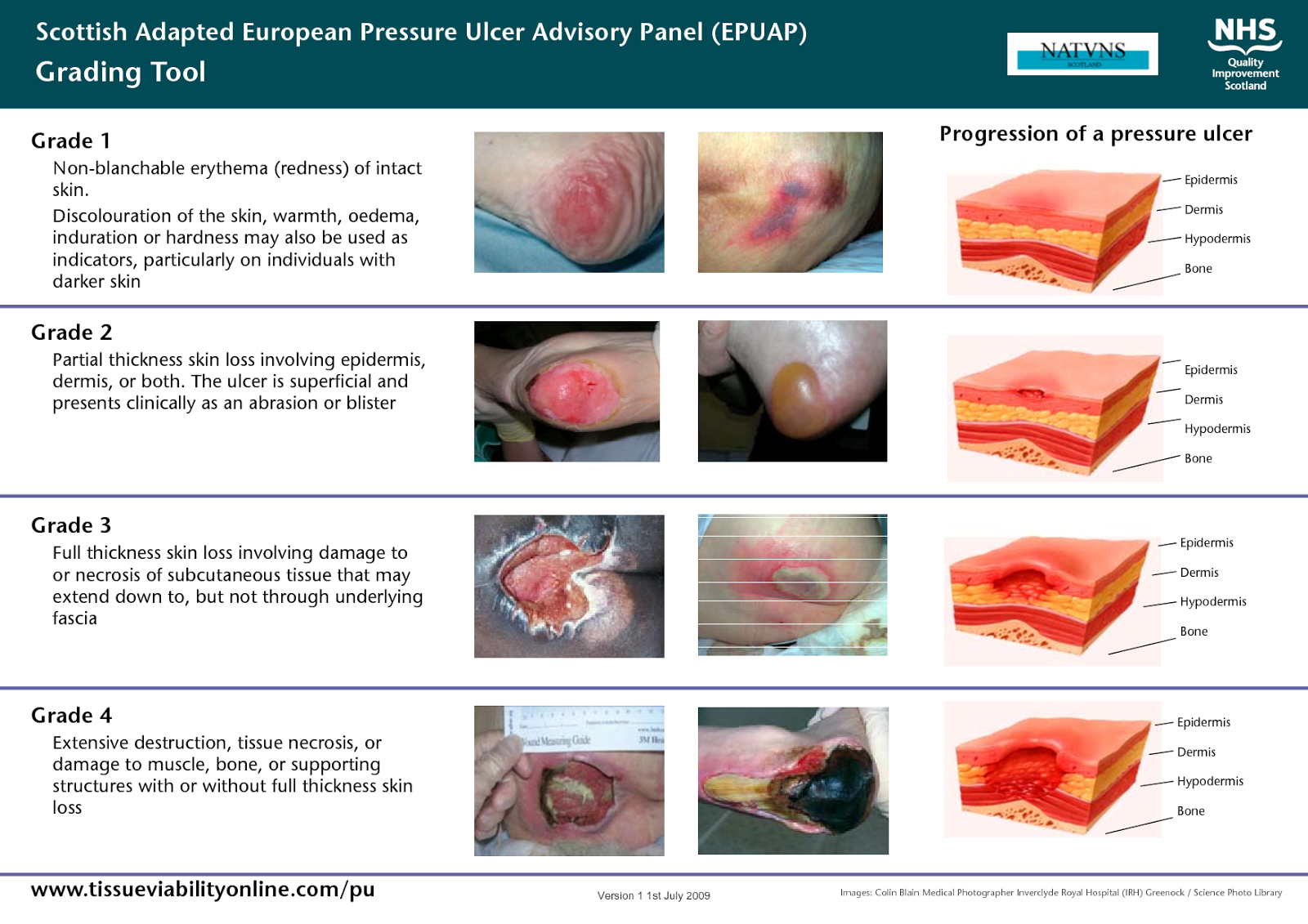 Chasing the Easterly Winds: Pressure Ulcers
