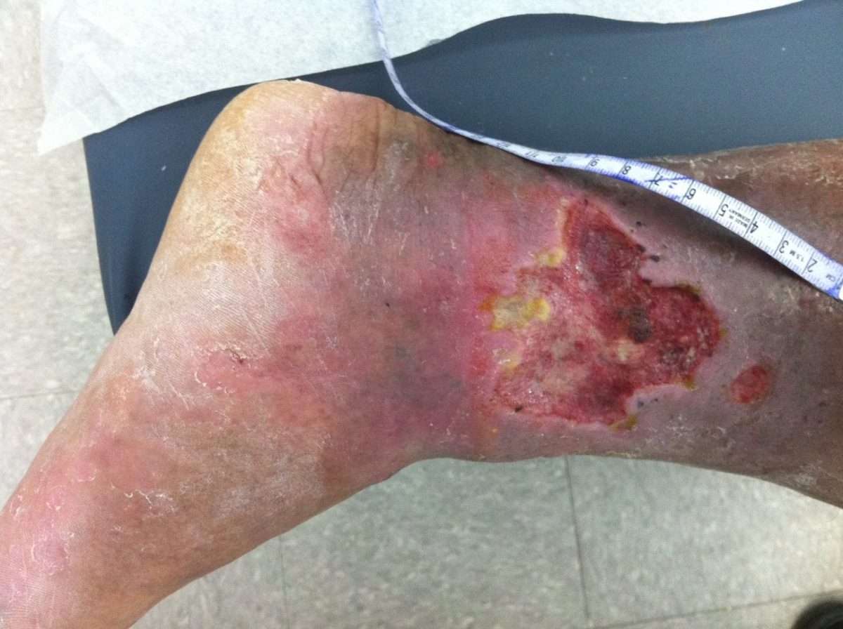 Chronic venous insufficiency ulcers : Step2