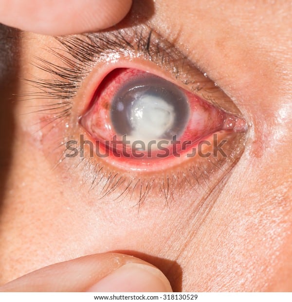 Close Severe Fungal Corneal Ulcer During Stock Photo (Edit Now) 318130529