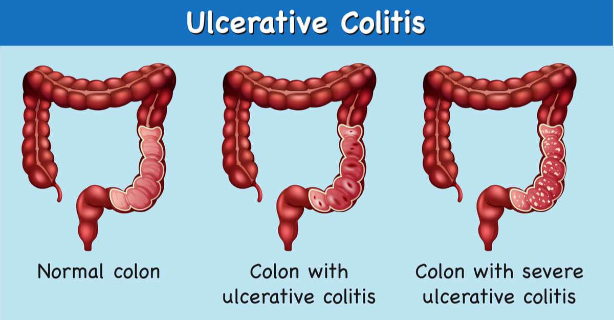 Colitis Ulcerosa: Hausmittel gegen Colitis Ulcerosa ...